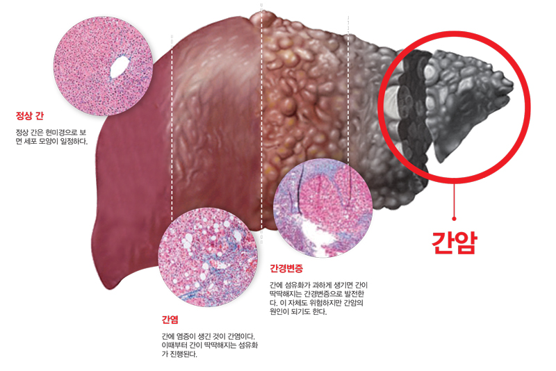 간암