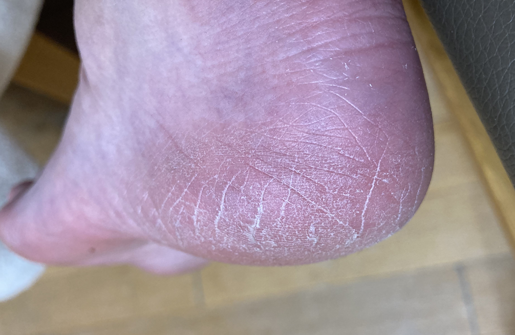 발뒤꿈치 갈라짐 사진