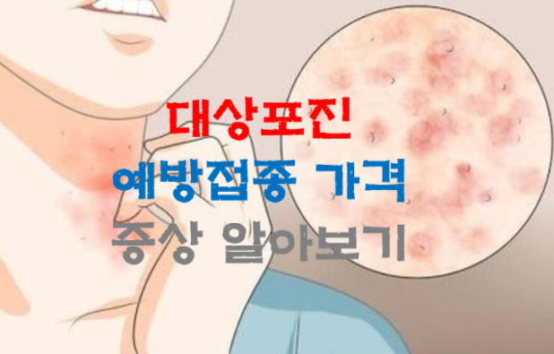 대상포진-증상