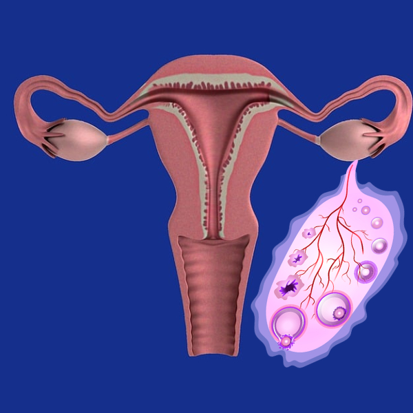 다낭성난소증후군