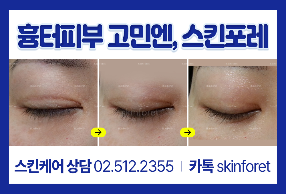 눈매교정 전후, 쌍꺼풀흉터 개선 스킨케어 사례