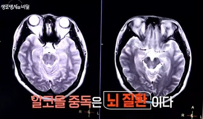 뇌질환