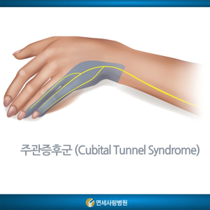 새끼 손가락 저림