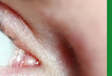 눈건강지키는법