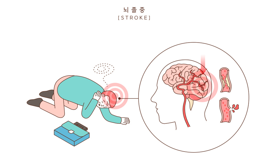 뇌졸증 이미지