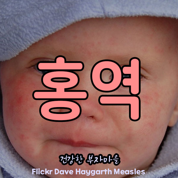 홍역_1