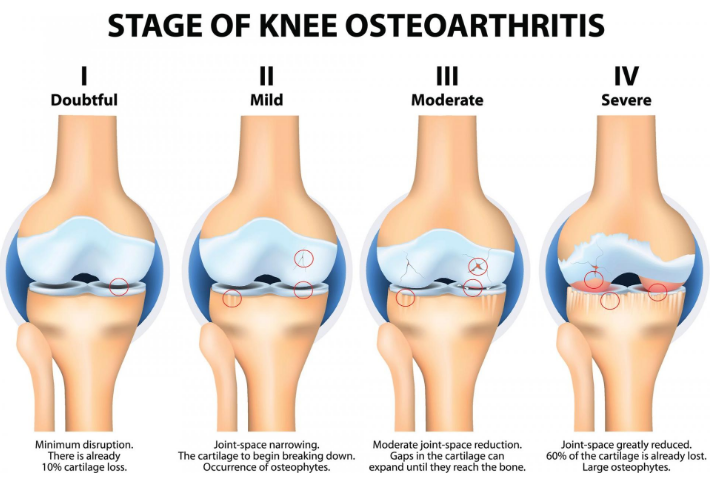 관절에 좋은 음식