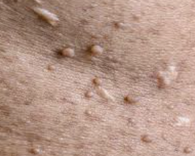 쥐젖 제거방법 13