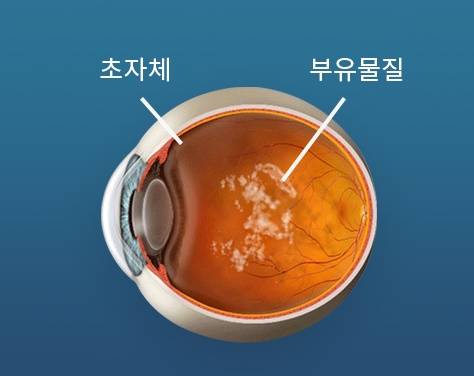 유리체 혼탁한 모습