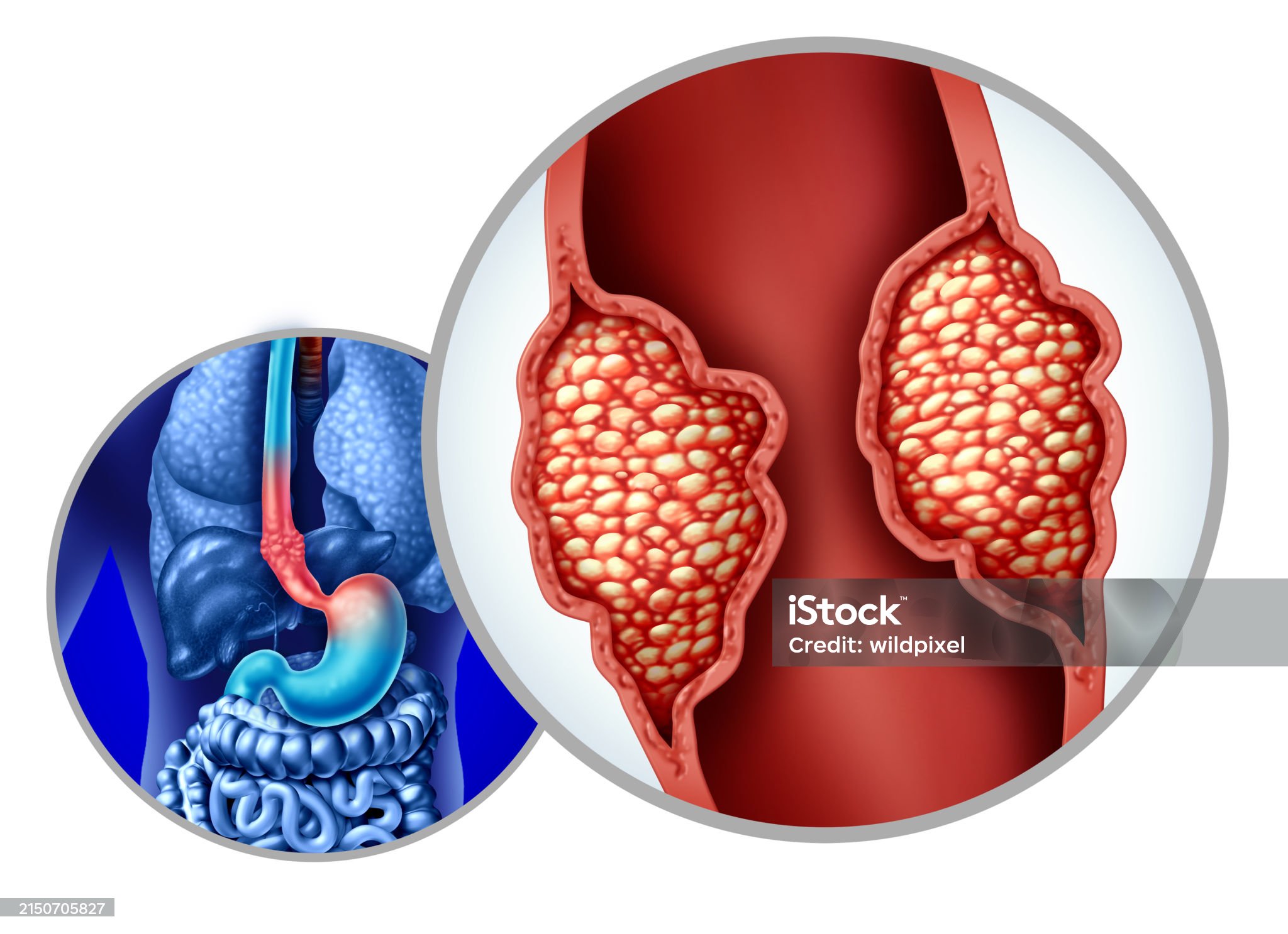 식도암-관련-사진