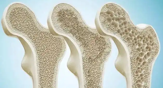 골다공증 치료제