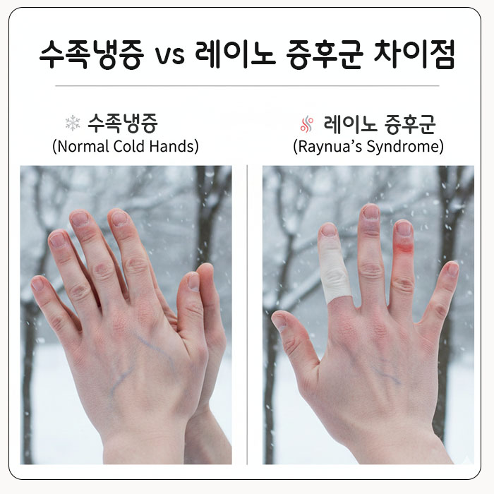 수족냉증 vs 레이노 증후군 차이점