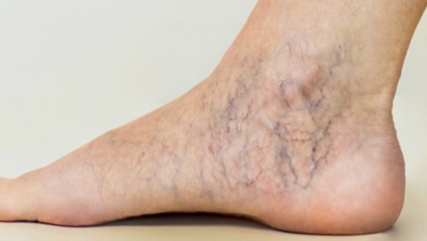 하지정맥류 초기증상과  예방법