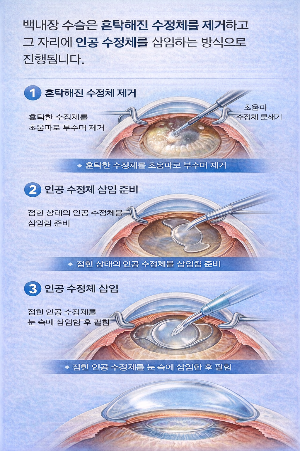 백내장 수술 과정 그림