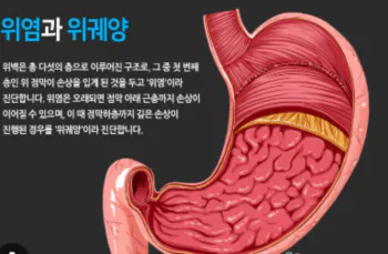 위염-사진
