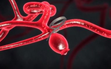 뇌동맥류 클립술