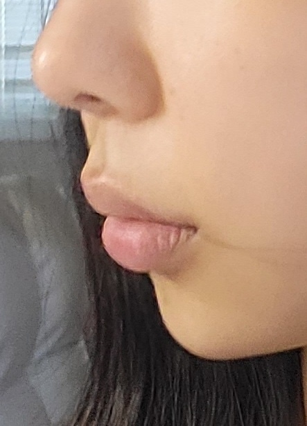 인중 축소 수술 후기