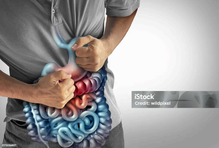 크론병(Crohn’s disease) 완벽 정리