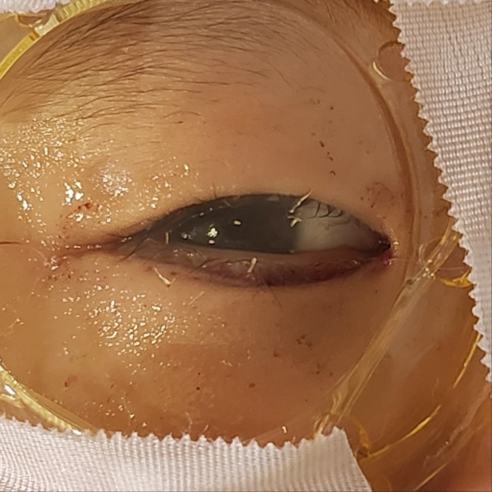 수술 당일 눈