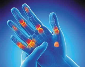 손가락 마디가 아픈이유 | 손가락 마디가 붓는 이유 | 손가락 관절염 치료법