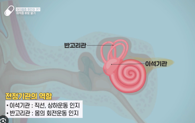 이석증 재발 막는 법