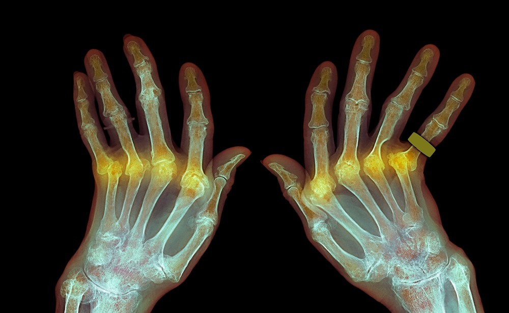 손가락-마디-통증-치료방법