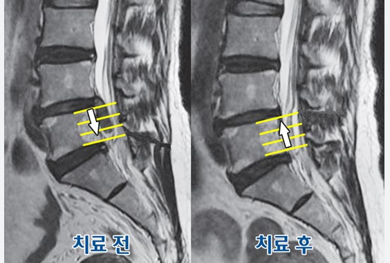 허리디스크 증상