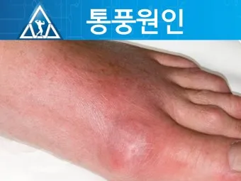 발가락 통풍 증상 및 대처방법_9