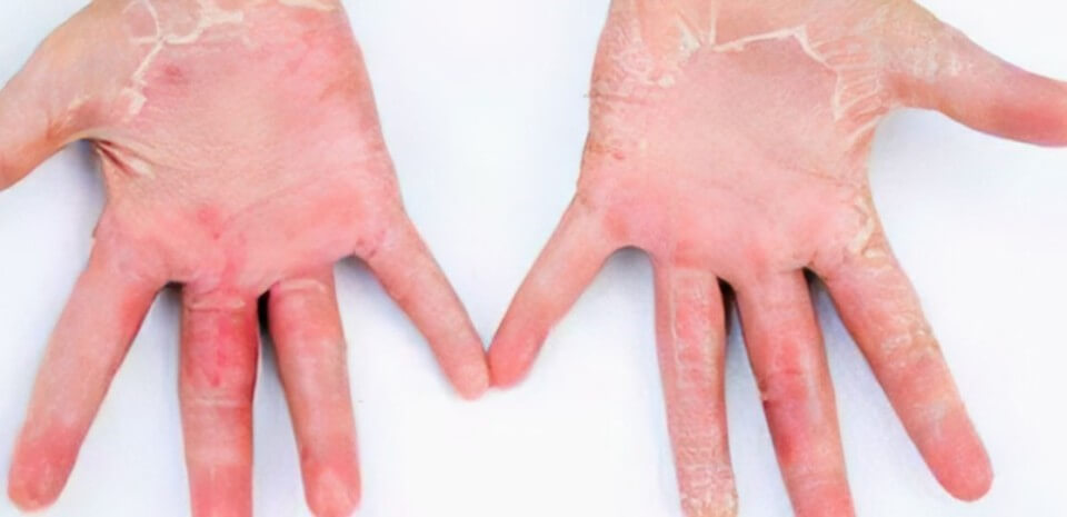 연쇄상구균독성쇼크증후군(STSS)