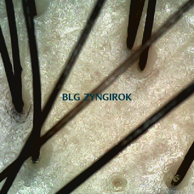 탈모 극복 프로젝트 - 정수리 두피 모습이다.