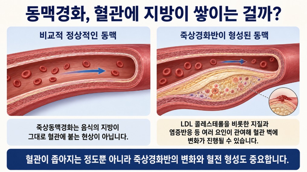 죽상동맥경화가 진행되면서 혈관 벽에 죽상경화반이 형성되고 혈관 안쪽 공간이 좁아지는 과정을 설명한 이미지