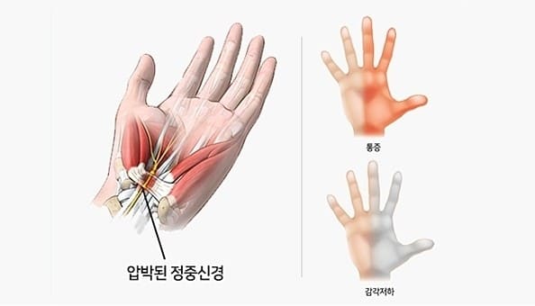 손목 통증&amp;#44; 손목 통증 원인&amp;#44; 손목 통증 치료방법&amp;#44; 손목 통증 병원&amp;#44; 손목 통증 완화운동&amp;#44; 손목 통증 약&amp;#44; 손목 손가락 통증&amp;#44; 손목 짚을때 통증&amp;#44; 손목 손등 통증&amp;#44; 테니스 손목 통증&amp;#44; 손목 통증 스트레칭&amp;#44; 손목 결절종 통증&amp;#44; 손목 터널 증후군&amp;#44; 손목 건초염&amp;#44; 손