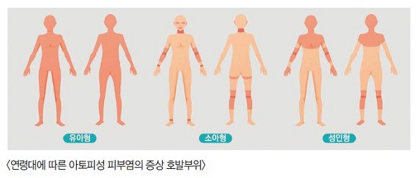 연령별로나눈 증상발현부위