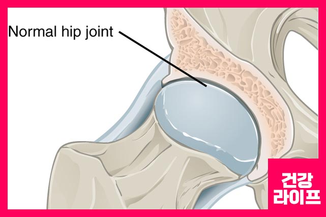 고관절 통증