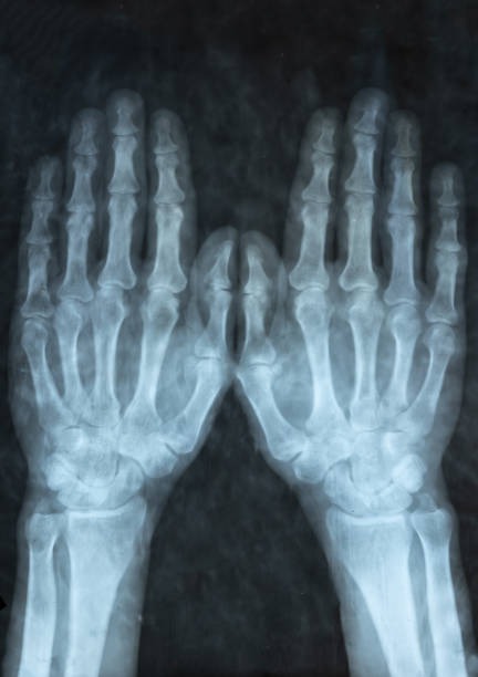 척골충돌증후군 원인