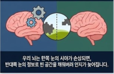 녹내장 초기증상