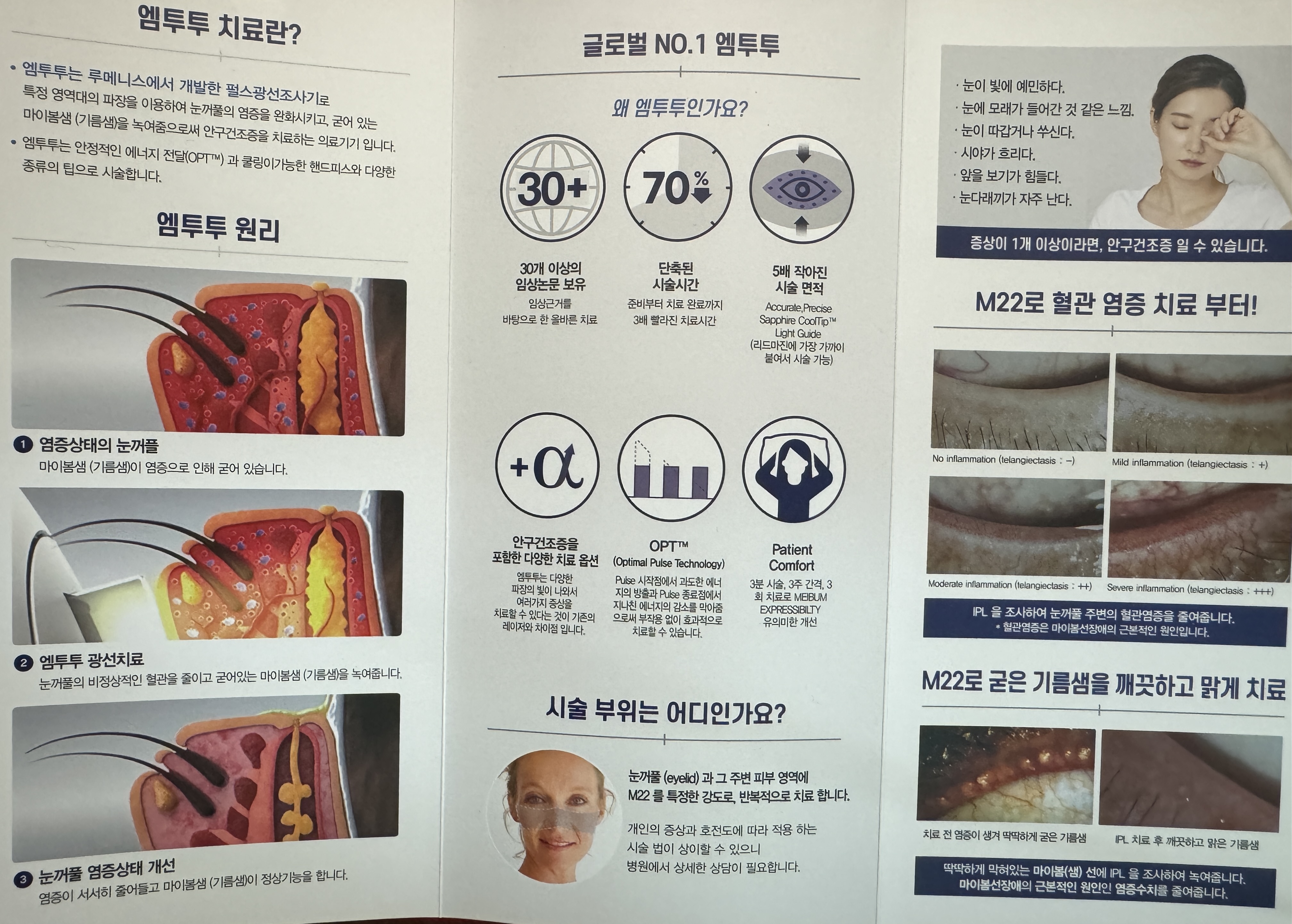 건조증 치료
