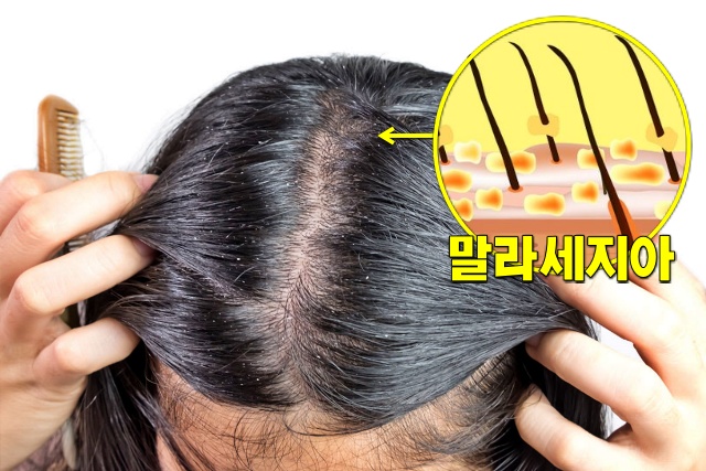비듬이 생기는 원인 5가지 말레세지아 진균 곰팡이 증식, 건강 팁줌 매일꿀정보