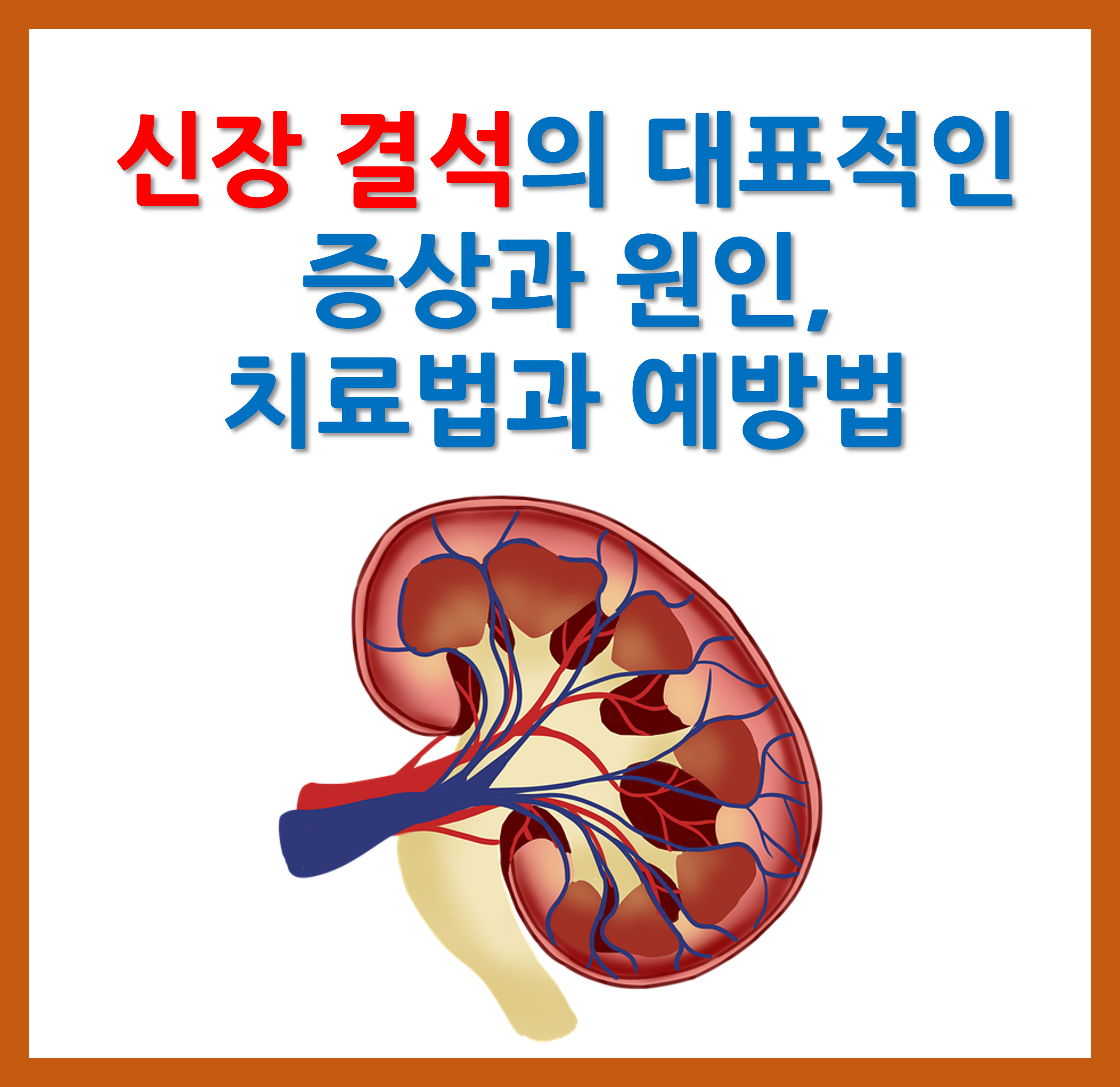 신장결석