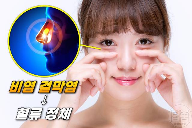 다크서클 원인 아이크림 추천 눈밑처짐 눈밑지방