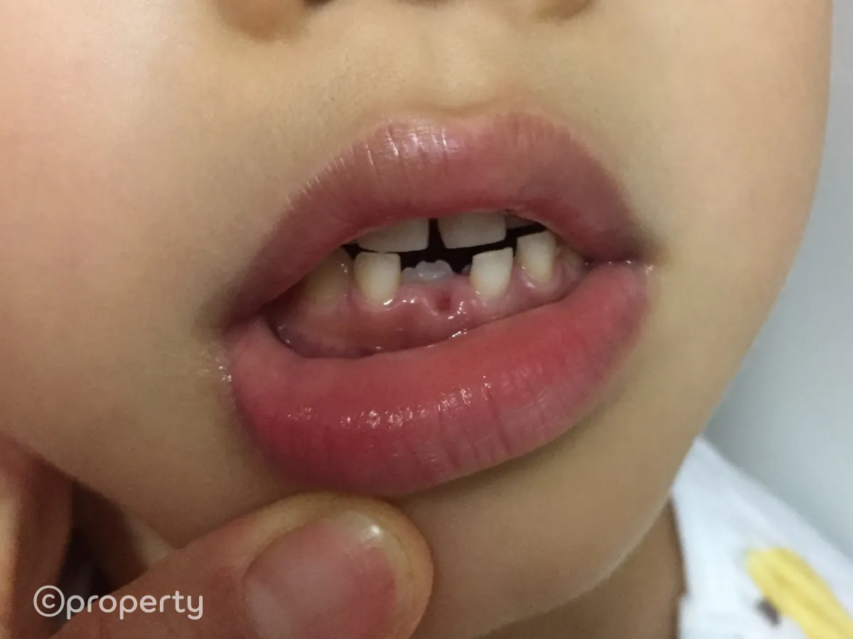 아이입-유치앞니-빠진자리-영구치앞니-나오고있는