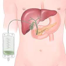 쓸개(담낭) 제거수술