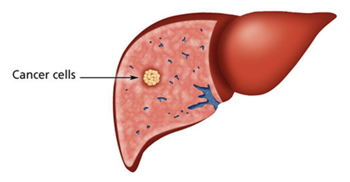간암의 주요원인