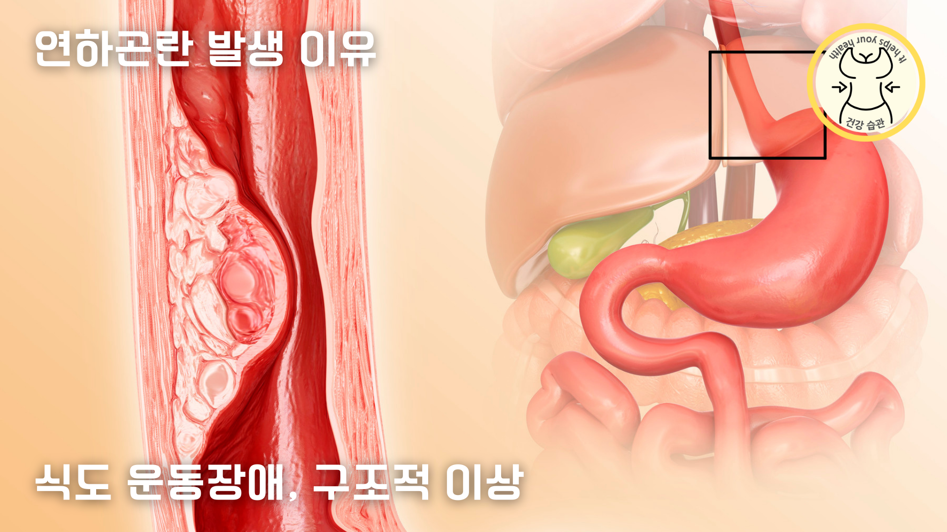 식도의 운동장애, 구조적 이상으로 인한 연하곤란