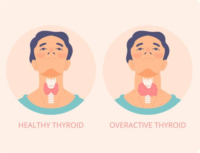 갑상선 기능 저하증 비교 분석