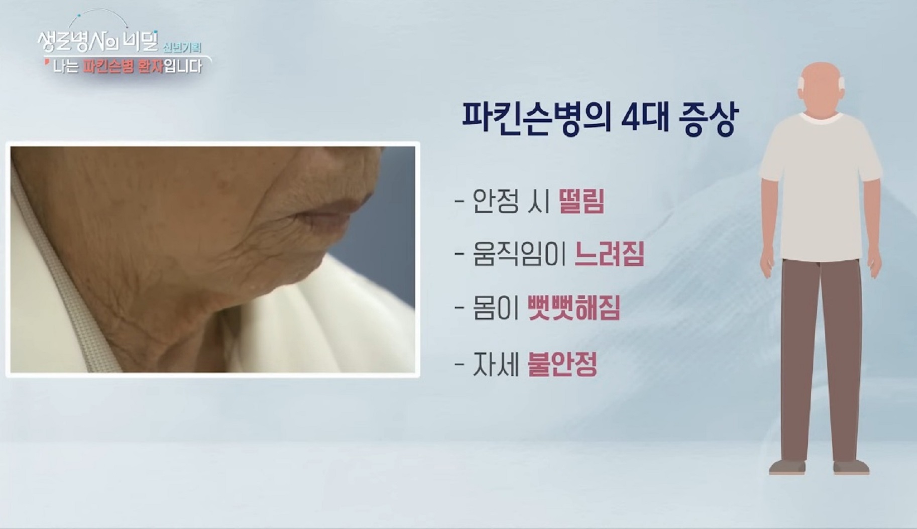 파킨슨-4대증상