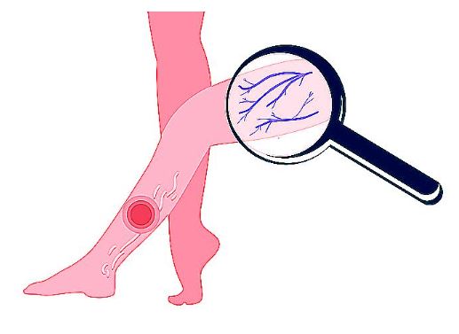 하지 정맥류 증상