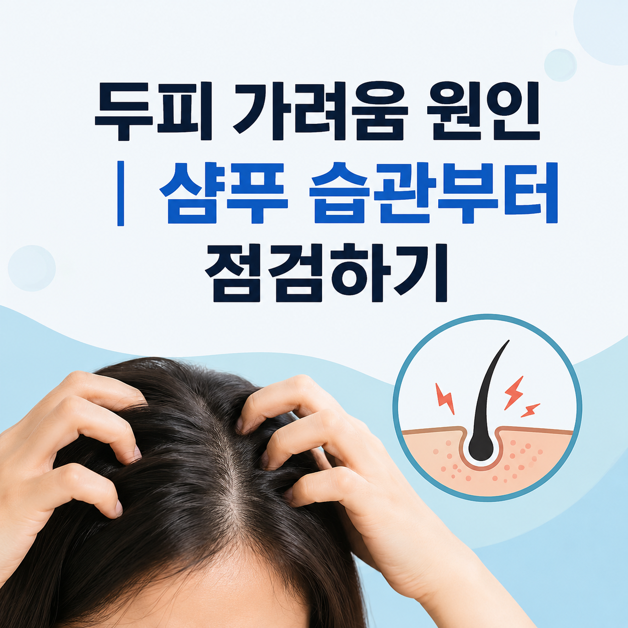 두피 가려움