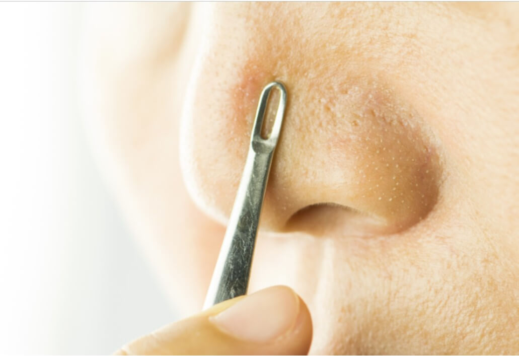 피지 자가 제거