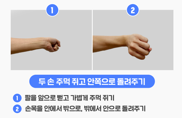 손목터널증후군 증상, 원인, 운동법